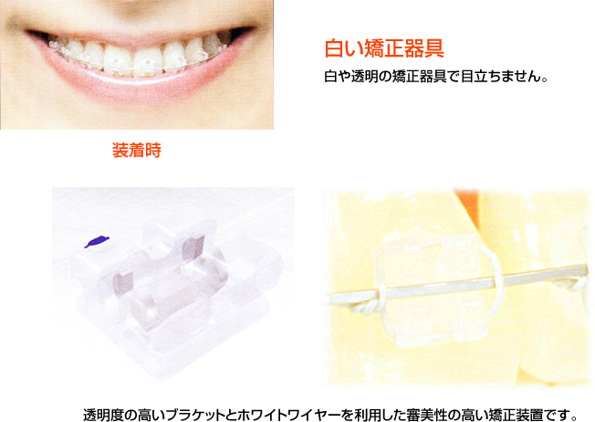 透明度の高いブラケットとホワイトワイヤーを利用した審美性の高い矯正装置です。