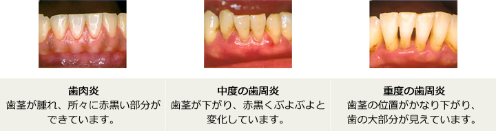 歯肉炎：歯茎が腫れ、所々に赤黒い部分ができています。／中度の歯周炎：歯茎が下がり、赤黒くぶよぶよと変化しています。／重度の歯周炎：歯茎の位置がかなり下がり、歯の大部分が見えています。