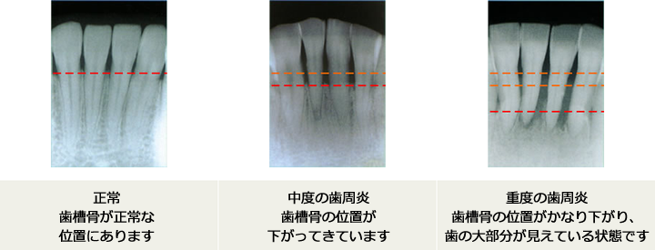 正常：歯槽骨が正常な位置にあります／中度の歯周炎：歯槽骨の位置が下がってきています／重度の歯周炎：歯槽骨の位置がかなり下がり、歯の大部分が見えている状態です